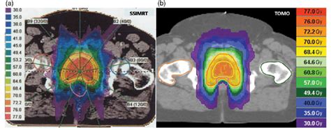 Examples Of Dose Distribution In Radiotherapy Of The Prostate Gland