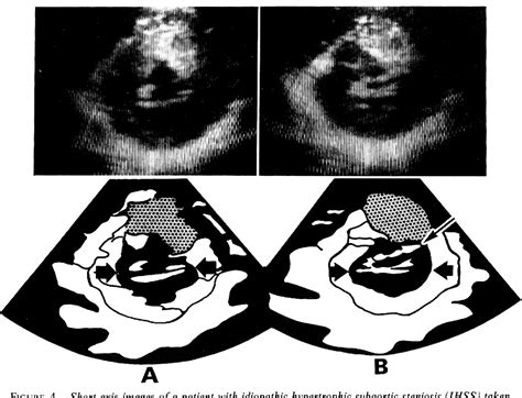 Idiopathic Hypertrophic Subaortic Stenosis Semantic Scholar