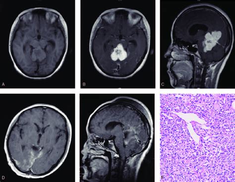 MRI Scanning And Pathological Analysis Of The Solitary Fibrous Tumor In