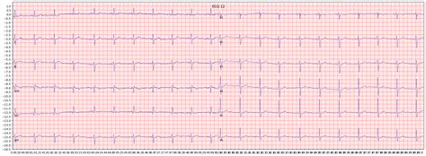 Examples of left anterior fascicular block (LAFB) | ECG Library