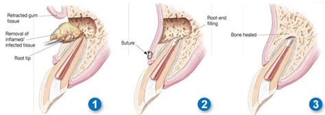 Apicoectomy - Colorado West Endodontics