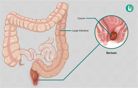 Rectal Cancer Symptoms Causes Treatment Doctor Medicine