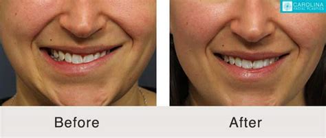 Asymmetrical Face Surgery Before And After