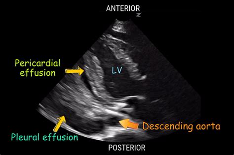 Pericardial Versus Pleural Effusion On Plax View Nephropocus