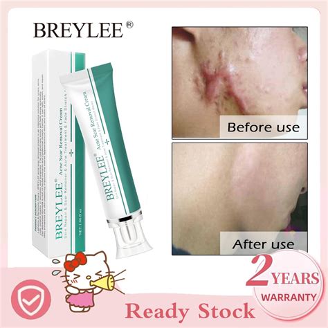 BREYLEE Acne Scar Removal Cream Skin Repair Scar Remover Acne Treatment