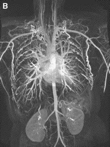 Three Dimensional Contrast Enhanced Mr Angiography Of The Thoraco