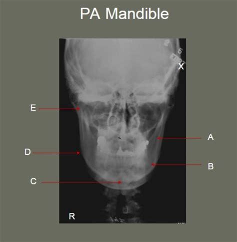 Pa Mandible Diagram Quizlet