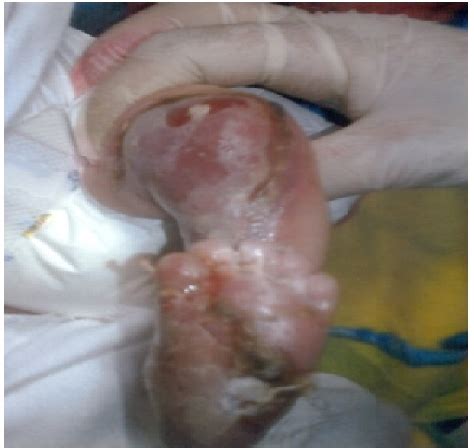 Figure From Aplasia Cutis Congenita A Rare Extensive Bilateral Case