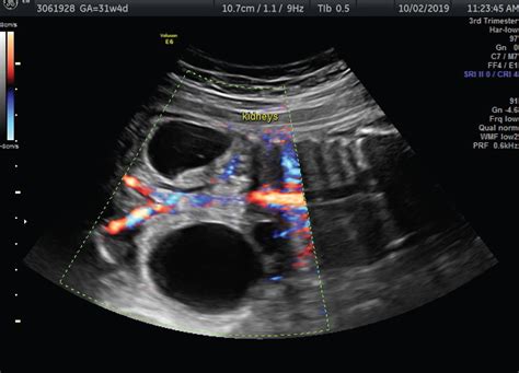 Antenatal Management Of Second Trimester Oligohydramnios And Evolving