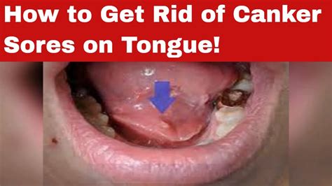 The Foolproof Guide On How To Get Rid Of Canker Sores On Tongue Youtube