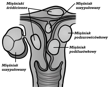 Mięśniaki macicy przyczyny diagnostyka i leczenie Centrum Medyczne