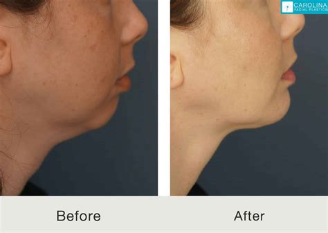 Chin Implant Buccal Fat Removal And Neck Liposuction To Contour The