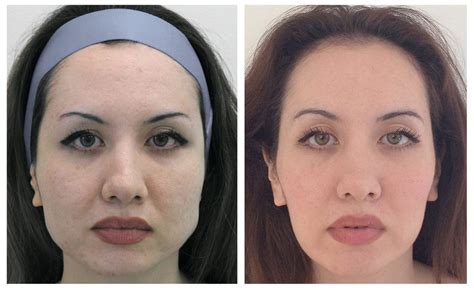 Non Surgical Facial Slimming Reshape Your Face Drbk