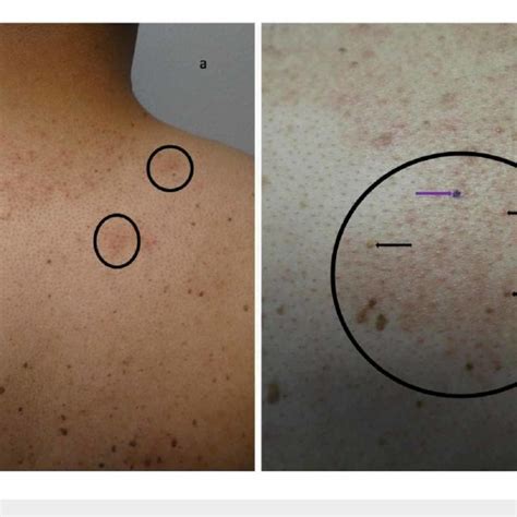 Malassezia Pityrosporum Folliculitis Incognito On The Posterior Neck