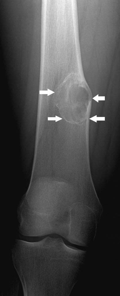 Benigne Knochentumoren Und Zysten Erkrankungen Des Rheumatischen