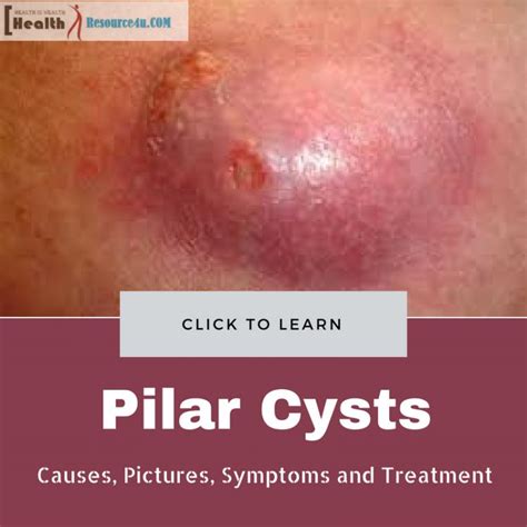 Multiple Pilar Cysts On Scalp Pilar Cyst Of The Scalp Open I I Will Have Him Smooth And