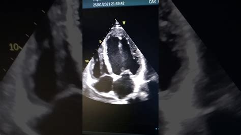 Spontaneous Echo Contrast In Left Atrium And Left Ventricle Where There S Smoke There S Fire