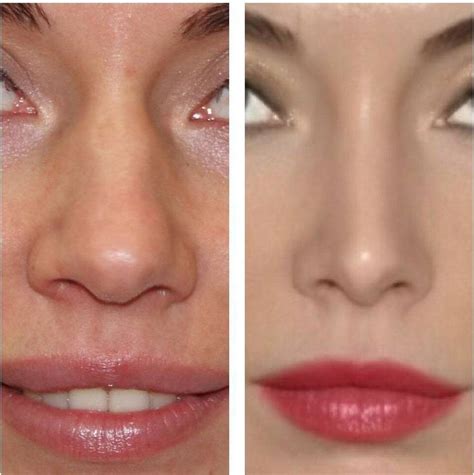 Pin by Pinner on Beautiful nose | Rhinoplasty nose jobs, Bulbous nose, Rhinoplasty