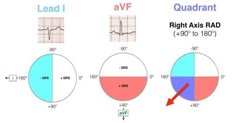 Ecg Axis Interpretation Litfl Medical Blog Ecg Library Basics