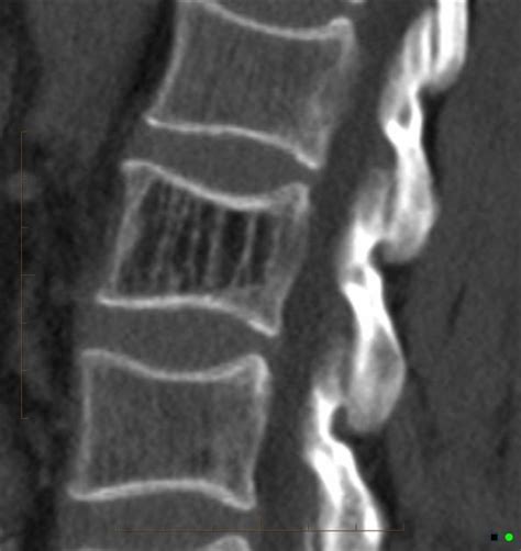 Vertebral Hemangioma Radiology Pk | Hot Sex Picture