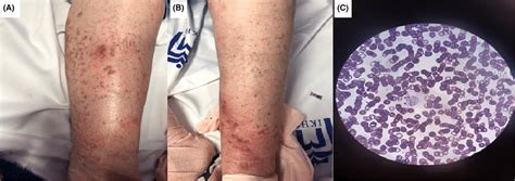 Patient 3 A And B Palpable Purpura And Non‐pitting Edema On Lower Download Scientific