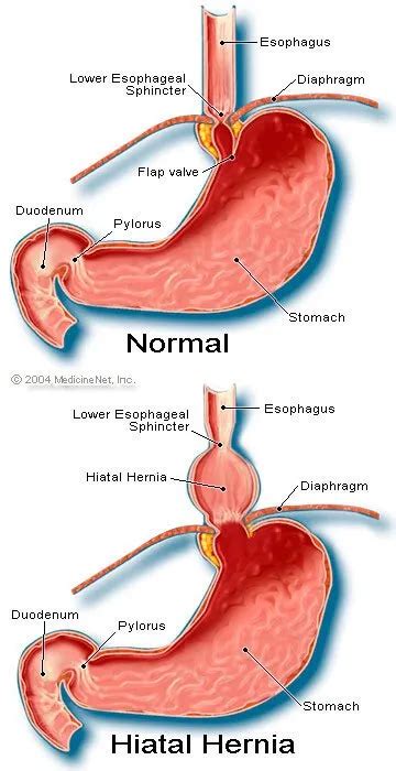 Hiatal Hernia Size Chart