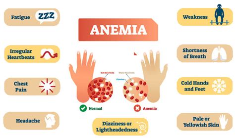 What Is Anemia Types Symptoms Causes Treatment Diet 46 Off