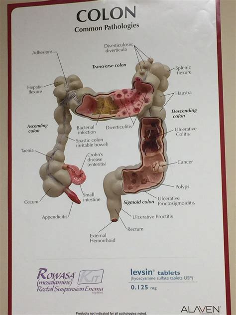 Colon Polyp Size And Type Charts Artofit