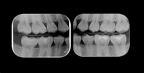 Radiografia Interproximal Exame Lima Radiologia Digital