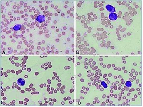 1 Various Morphologies Of Promyelocytes In Apl A Apl With Large