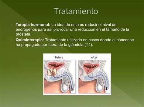 Hiperplasia Prost Tica Benigna C Ncer De Pr Stata Y Urolitiasis Ppt