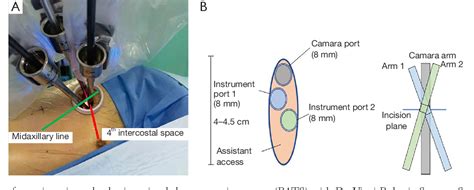 Figure 2 From A Uniportal Right Upper Lobectomy By Three Arm Robotic