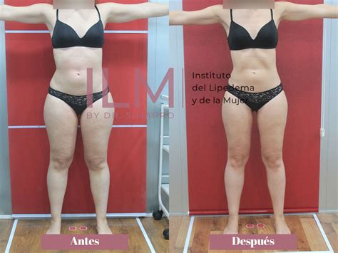 Resultados de nuestro tratamiento del lipedema sin cirugía INSTITUTO