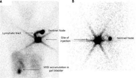 Figure From The Efficacy Of Tc M Sestamibi For Sentinel Node