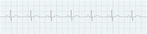 Qrs Interval