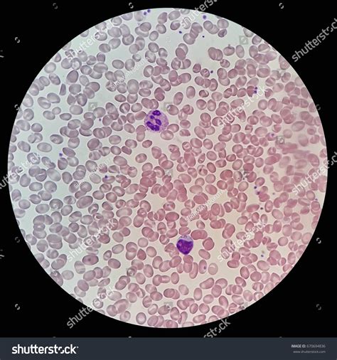 Human Blood Smear Abnormal Red Blood Stock Photo 670694836 | Shutterstock