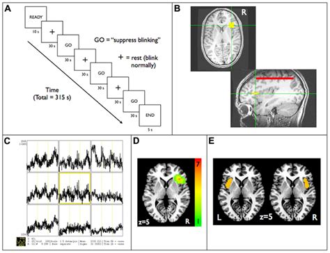 Functional Localization Of The Anterior Ric A Real Time Fmri