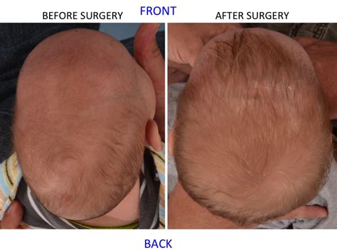 Minimally Invasive Endoscopic Sagittal Strip Craniectomy Before And