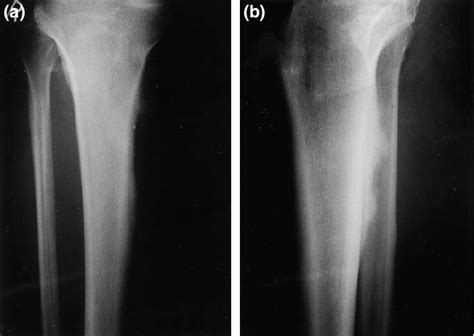 Anteroposterior A And Lateral B Radiographs Showing Progression Of Download Scientific