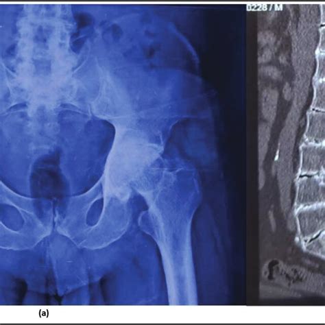 Case Ii A Plain Radiograph Of Pelvis With Both Hips Demonstrating Download Scientific