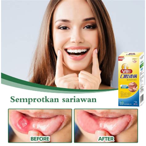 Jual Original Obat Sariawan Obat Sariawan Pengobatan Pereda Sakit