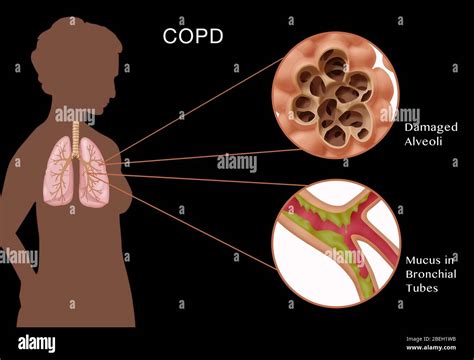 Chronische Obstruktive Lungenerkrankung Stockfotos Und Bilder Kaufen