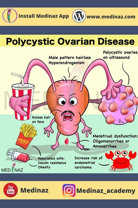 Polycystic Ovarian Disease Pcod Mnemonic Medical School Stuff