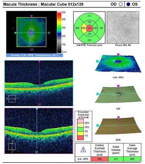 Normal Oct Macula