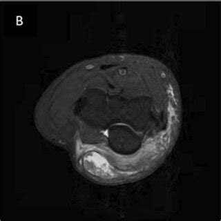 A 28-year-old male patient who underwent an MRI of the elbow joint and ...