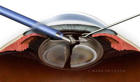 Cross Section Illustration Of Phaco Cataract Surgery