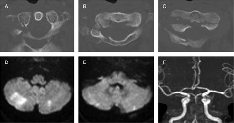 Axial Cervical Ct Scans A C Revealed C1 Right Posterior Arch Fracture