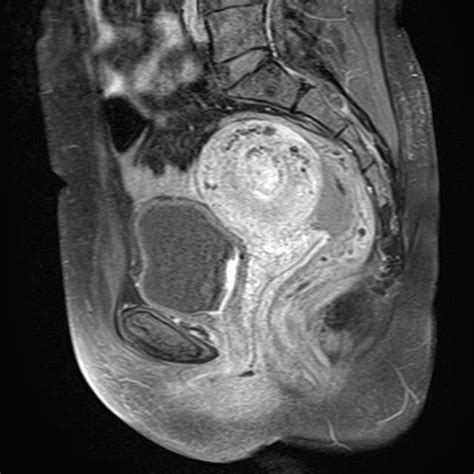 Uterine Arteriovenous Malformation Image