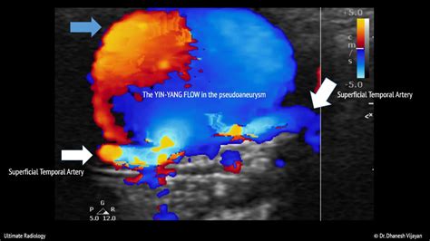 Ultimate Radiology Superficial Temporal Artery Pseudoaneurysm