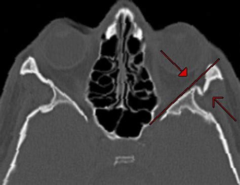 Evaluation Of Fixation Techniques With Titanium Plates And Kirschner